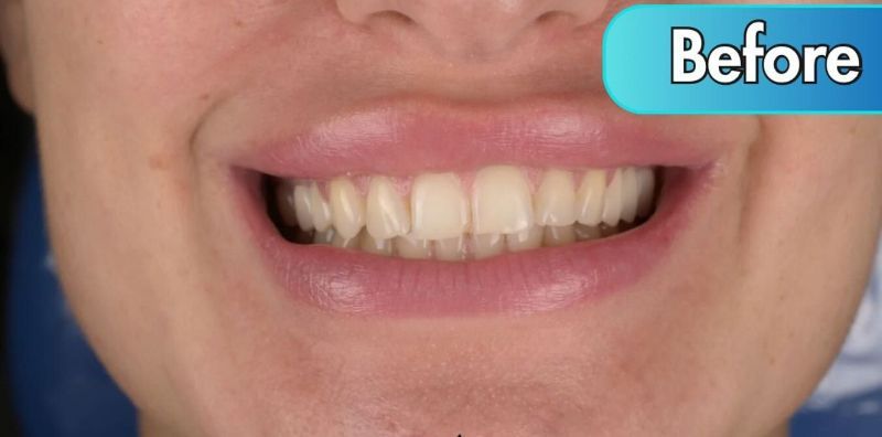 A close up of a person 's mouth with a before sign above it