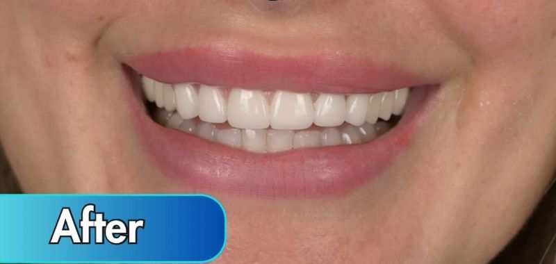 A close up of a woman 's smile with the words after below it