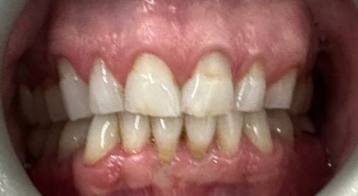 A close up of a person 's teeth with red gums