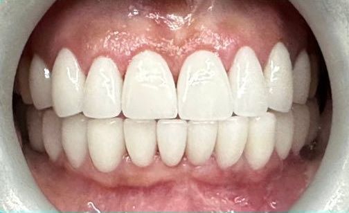 A close up of a person 's teeth with white teeth.