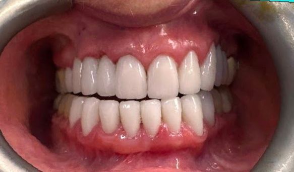 A close up of a person 's mouth with white teeth.