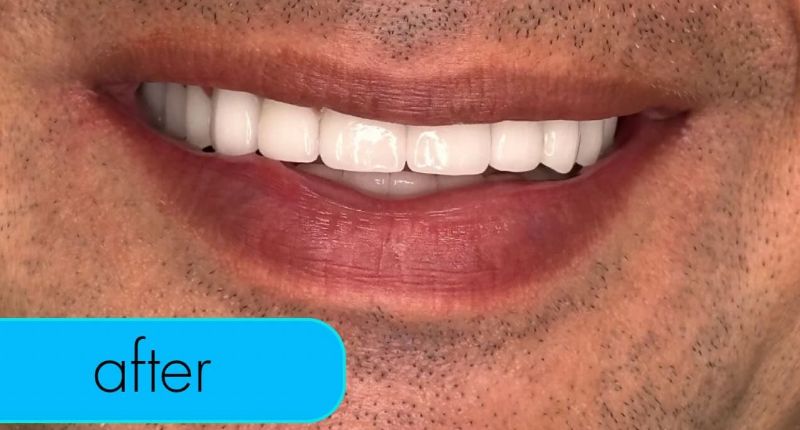 A close up of a man 's mouth with white teeth.