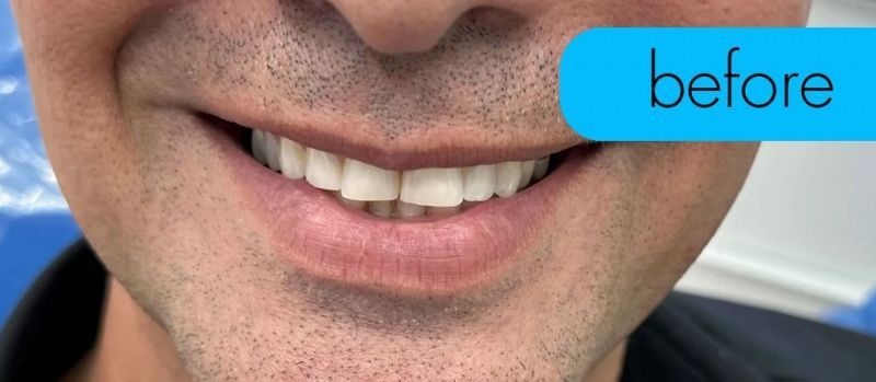 A close up of a man 's smile with a before sign.