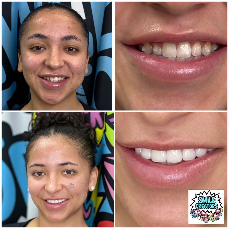 A before and after photo of a woman 's smile with the smile creators logo