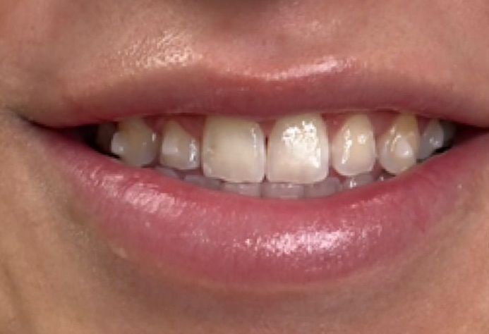 A close up of a woman 's mouth with white teeth.