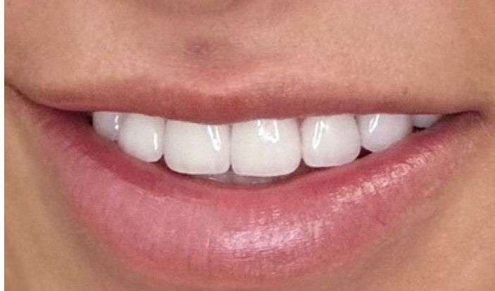 A close up of a woman 's mouth with white teeth.