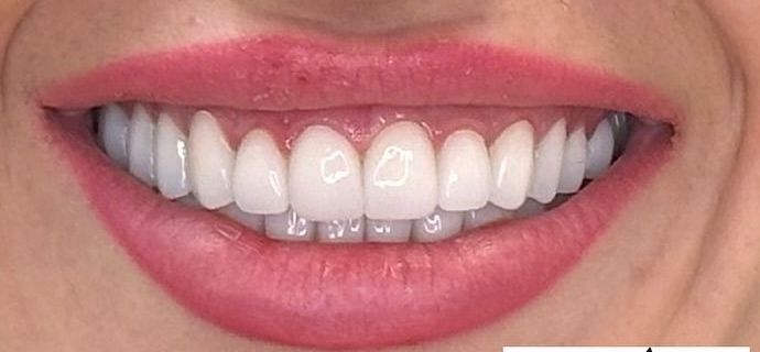 A close up of a woman 's smile with white teeth and pink lips.