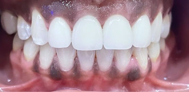 A close up of a person 's teeth with white teeth.