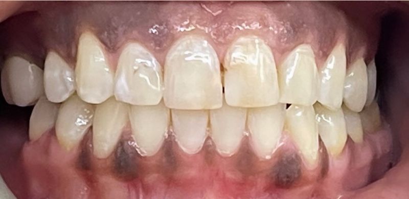 A close up of a person 's teeth with a few black spots on them.