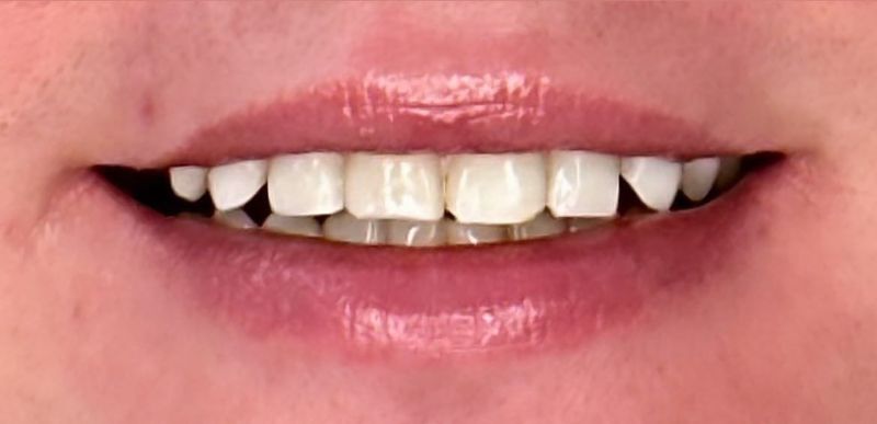 A close up of a woman 's mouth with white teeth.
