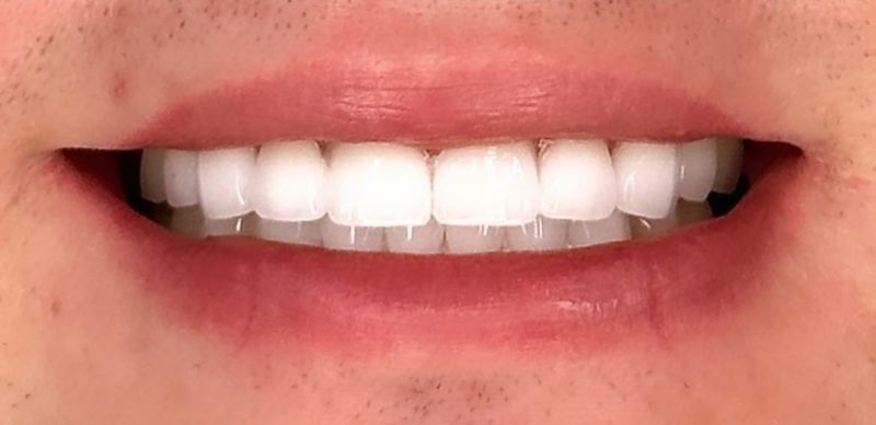 A close up of a man 's mouth with white teeth.