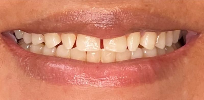 A close up of a person 's mouth with a missing tooth.