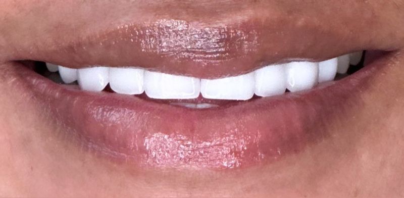 A close up of a woman 's smile with white teeth.