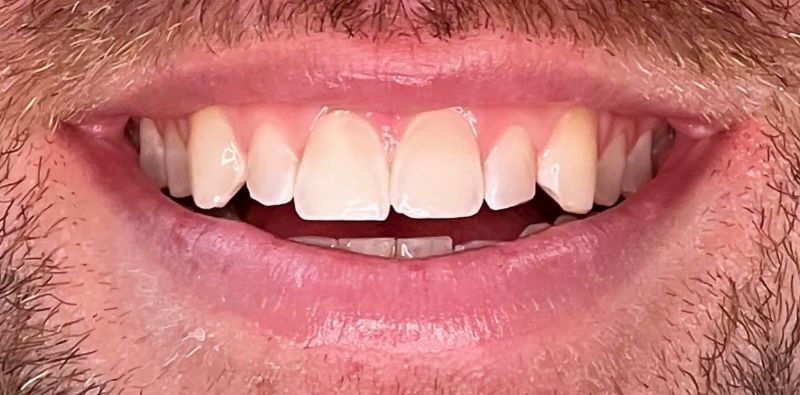 A close up of a man 's teeth with a beard.
