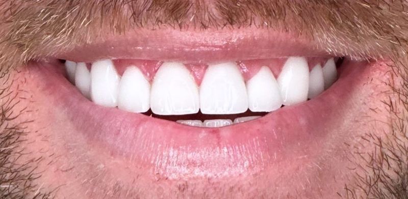 A close up of a man 's mouth with white teeth.