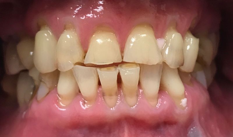 A close up of a person 's teeth with a broken tooth.