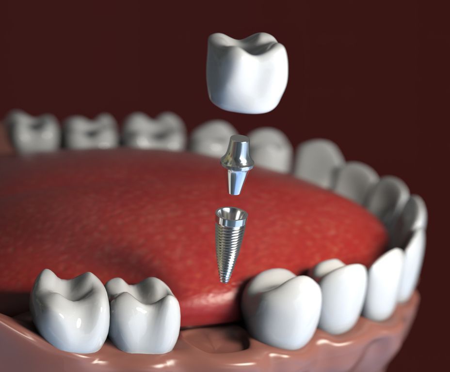 A model of a tooth with a dental implant in it