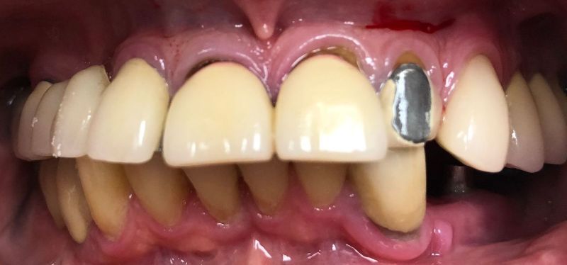 A close up of a person 's teeth with a metal crown on one of them.