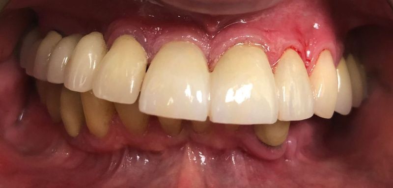 A close up of a person 's teeth and gums.