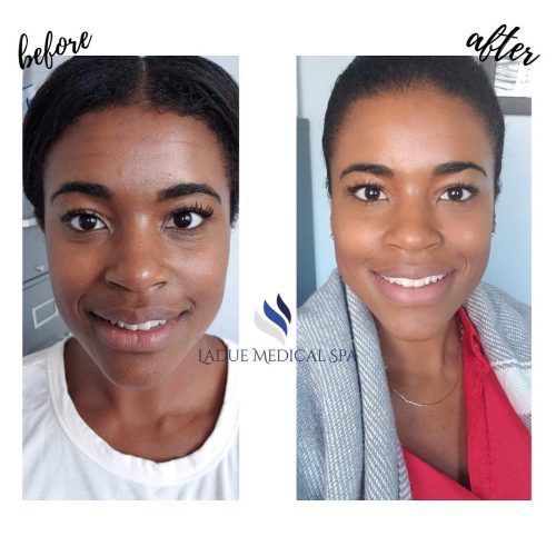 Before and After Botox