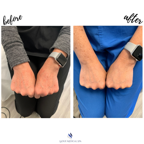 Before and After of IPL treatment