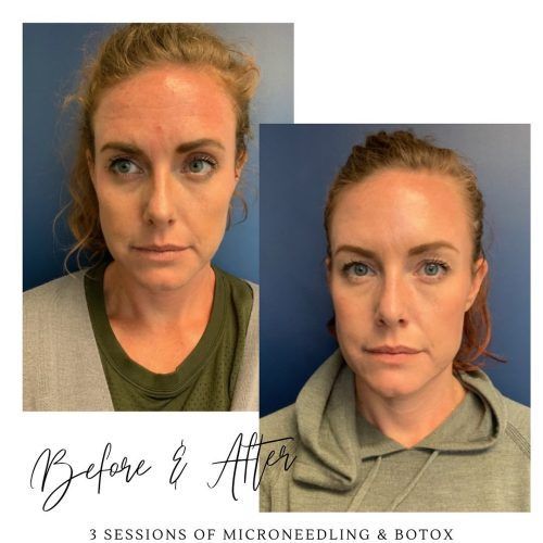 Microneedling Before and After