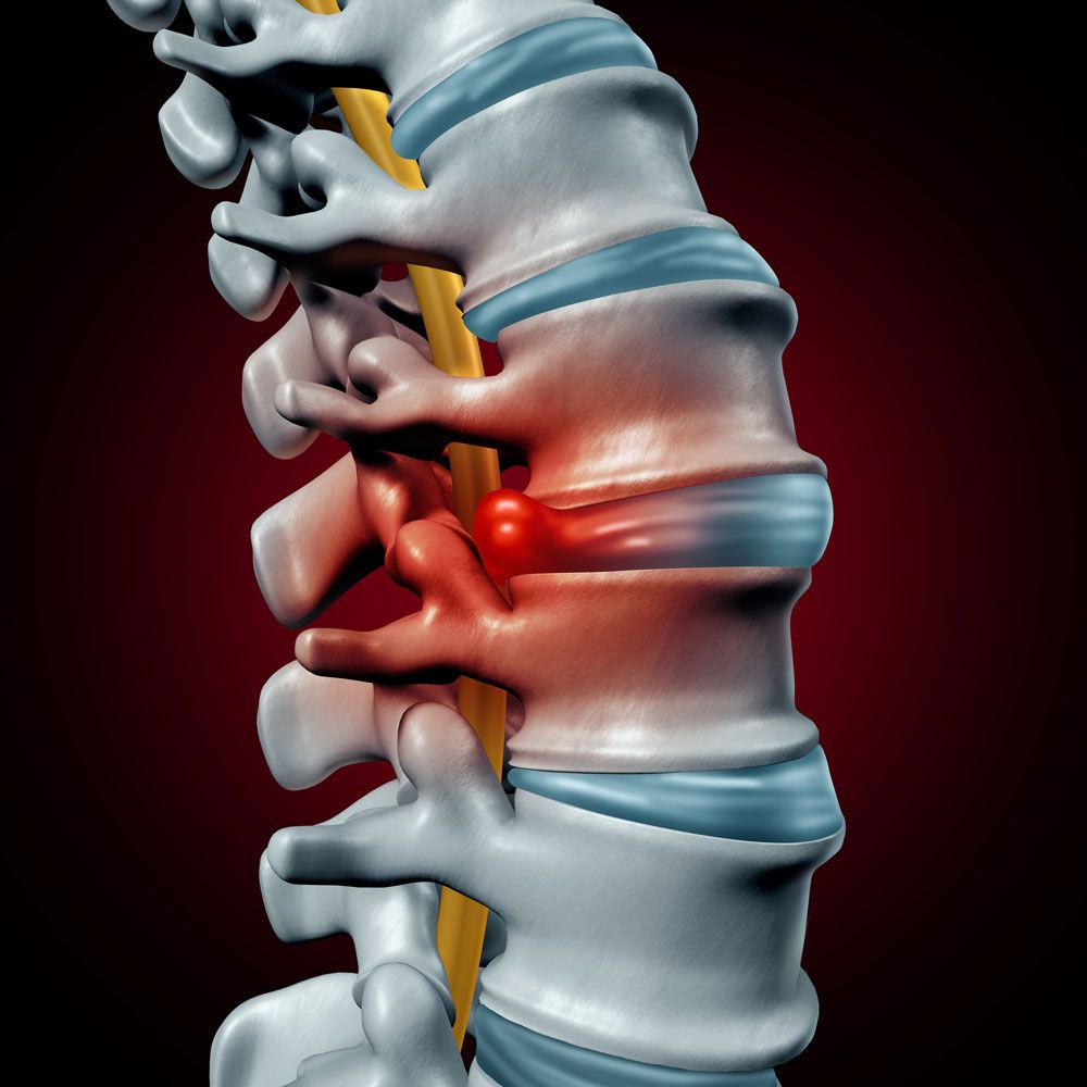 A computer generated image of a spine with a disc in it