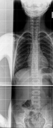 It is a black and white x-ray of a person 's chest and stomach. It is a black and white x-ray of a person 's chest and stomach.