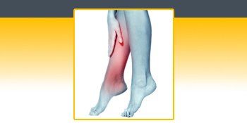 A picture of a person 's leg with a broken bone. A picture of a person 's leg with a broken bone.