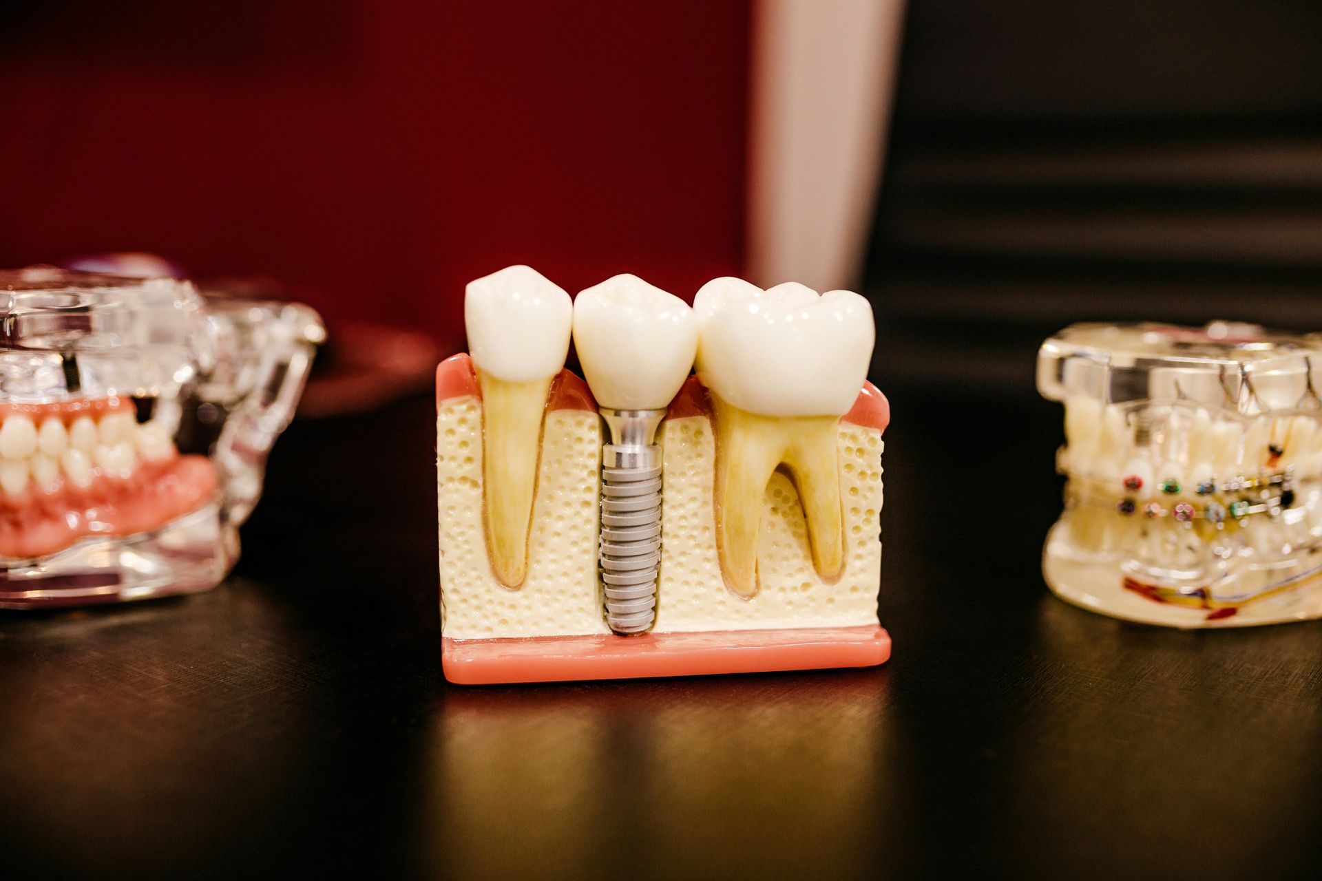 Model of a tooth implant with adjacent teeth, on a black surface, dental office setting.
