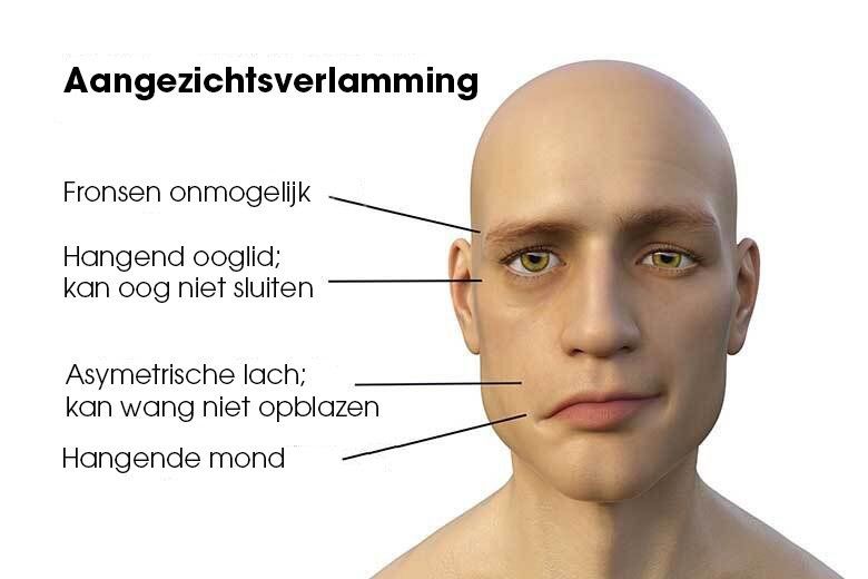 Bells Palsy