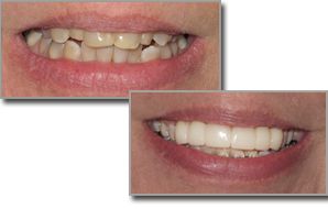A before and after picture of a woman 's teeth .