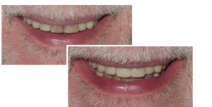 A before and after picture of dental crowns