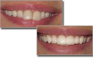 A before and after picture of dental veneers