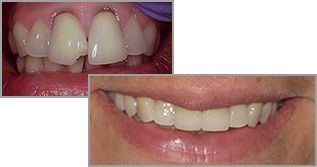 A before and after picture of dental crowns
