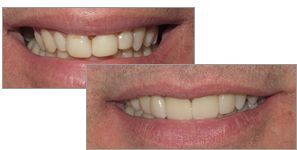 A before and after picture of dental veneers