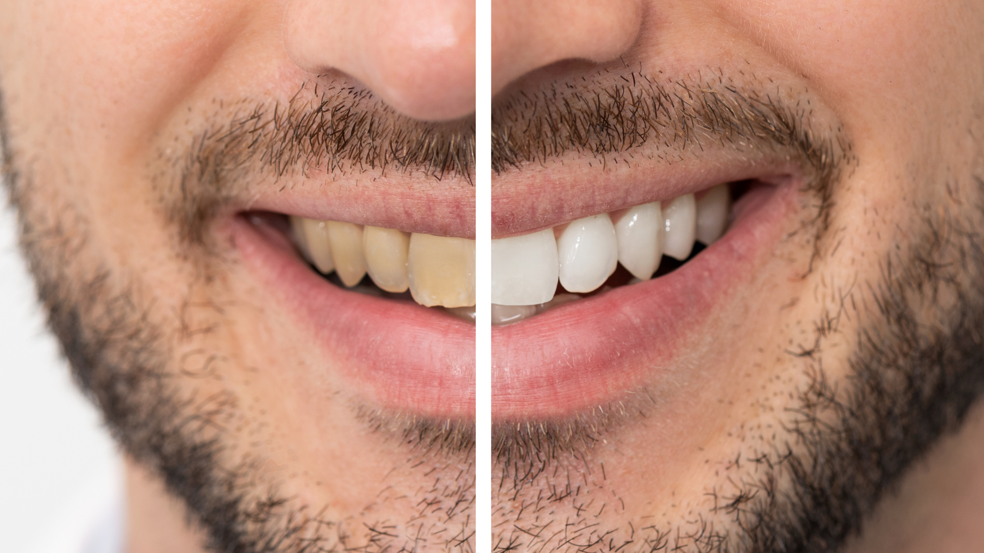 Comparison of teeth: left side stained, right side whitened.