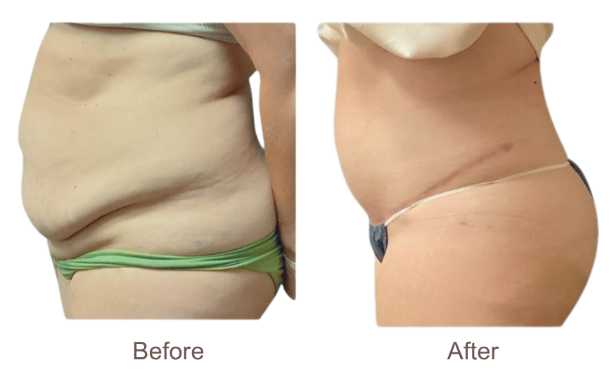 Comparison of abdomen before and after cosmetic surgery, showing visible reduction in excess skin.