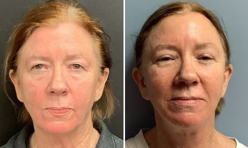 Associates in Plastic Surgery Brow Lift