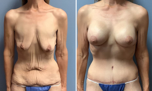 Associates in Plastic Surgery Mommy Makeover