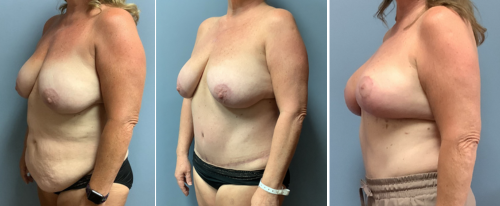 Associates in Plastic Surgery Breast Lift