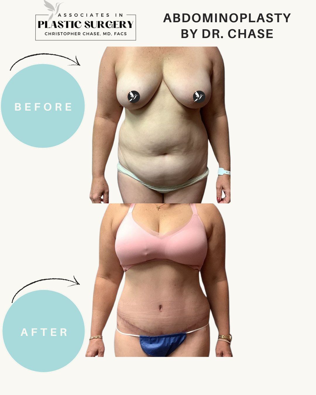 Before and after abdominal surgery results. The