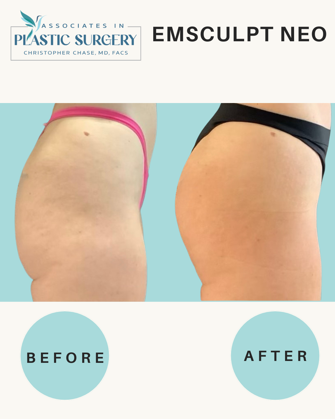Before and after comparison of a buttocks area, with noticeable reduction in cellulite after Emsculpt Neo treatment.