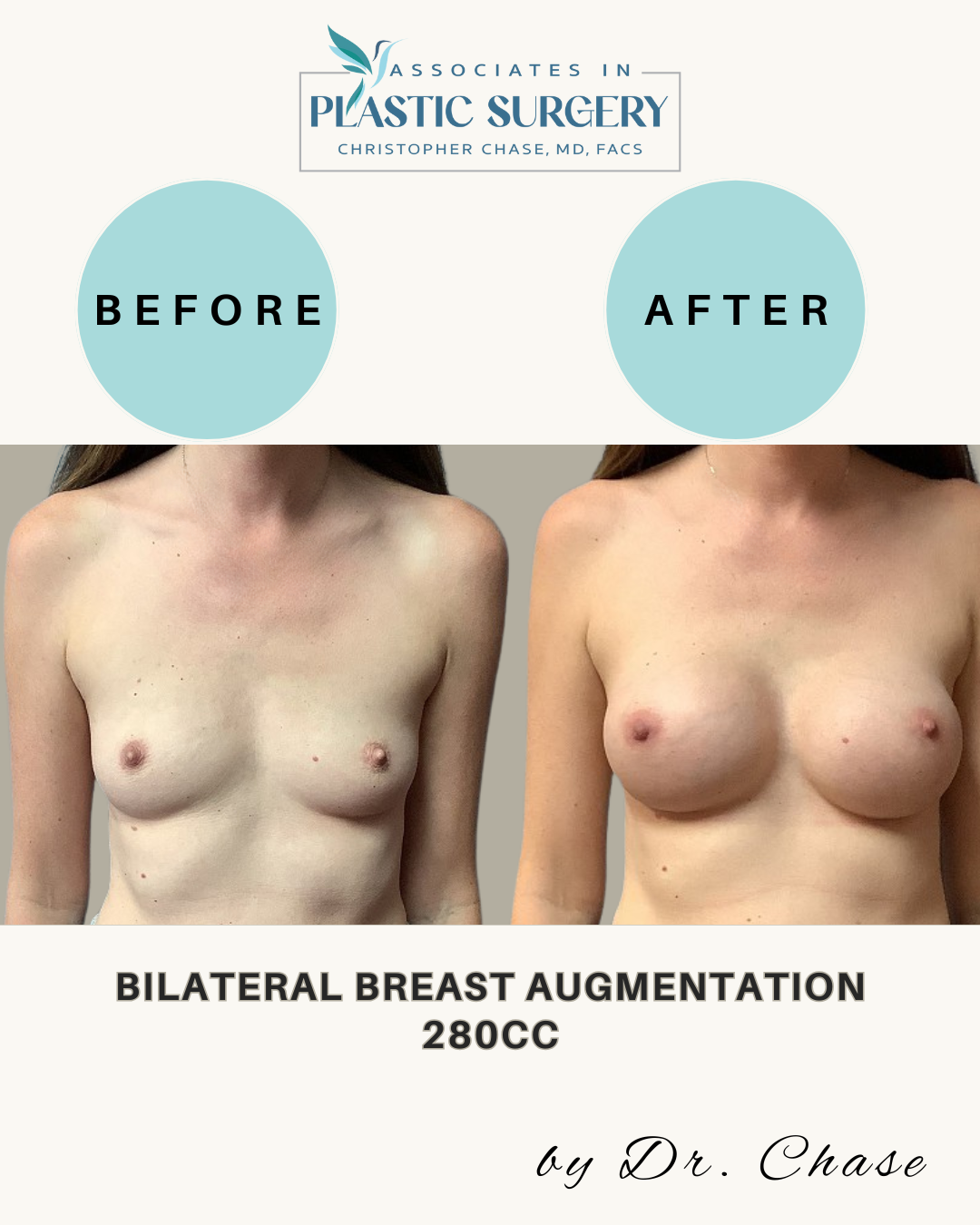 Before and after comparison of breast augmentation, featuring a person's torso. The 