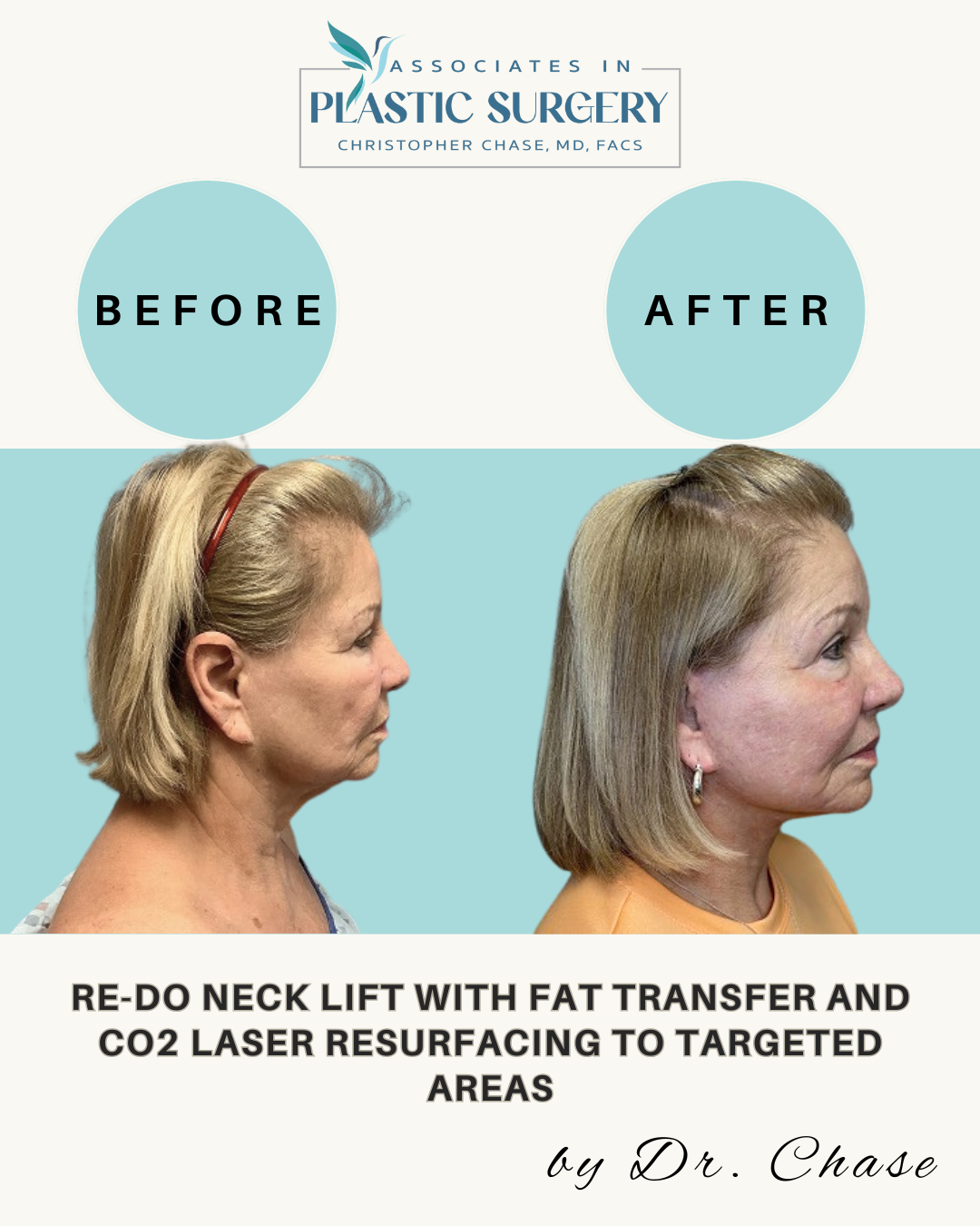 Before and after photos showing neck lift results with fat transfer and CO2 laser resurfacing.