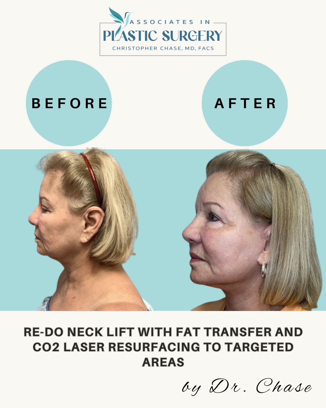 Before and after side profile comparison of a woman's neck, after a neck lift and laser resurfacing procedure.