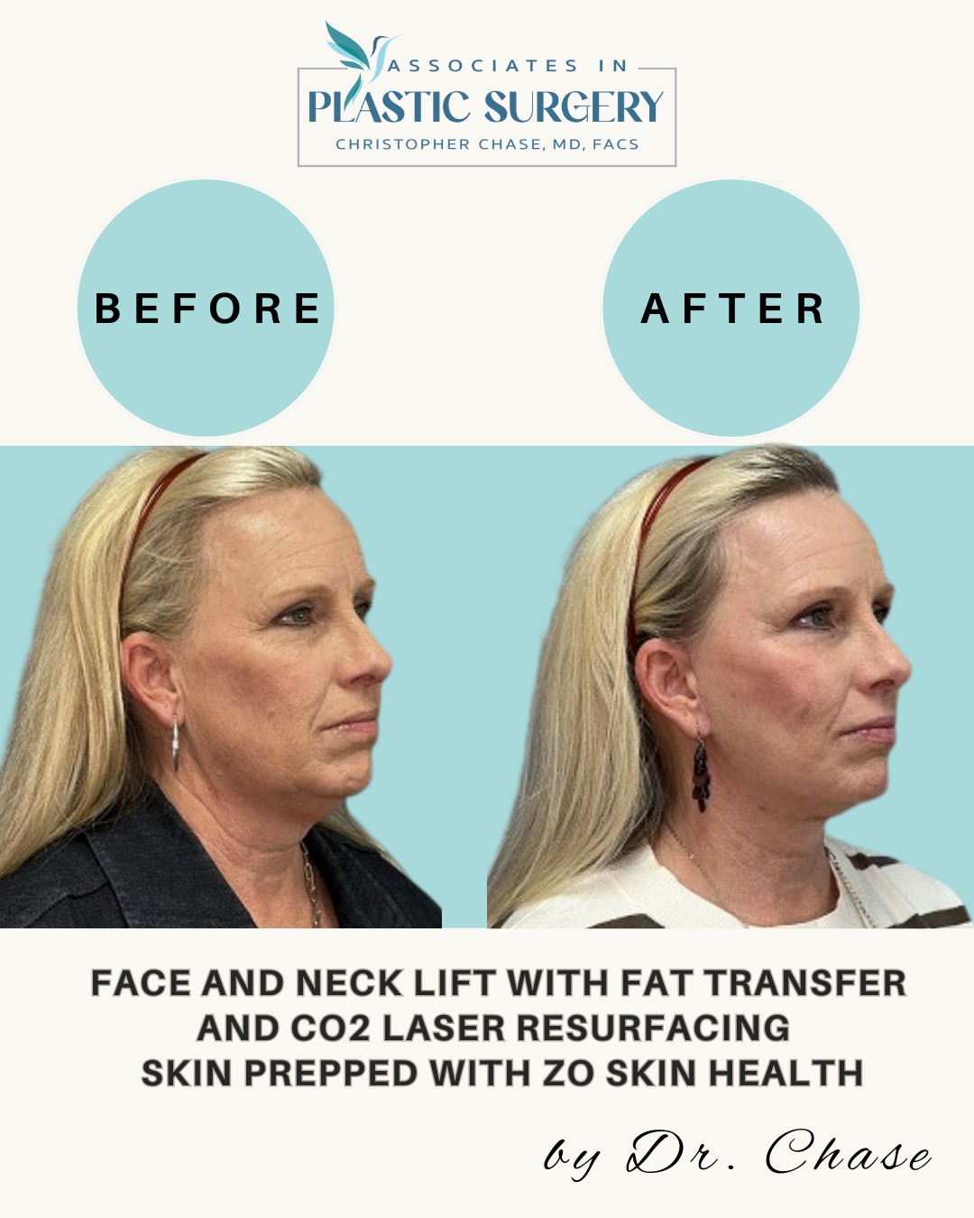 Comparison of a woman's face and neck before and after a lift, fat transfer, and CO2 laser resurfacing.