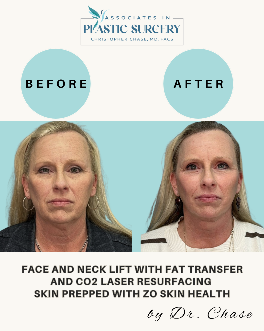 Before and after photos of a woman's face and neck lift, with fat transfer, and CO2 laser resurfacing.