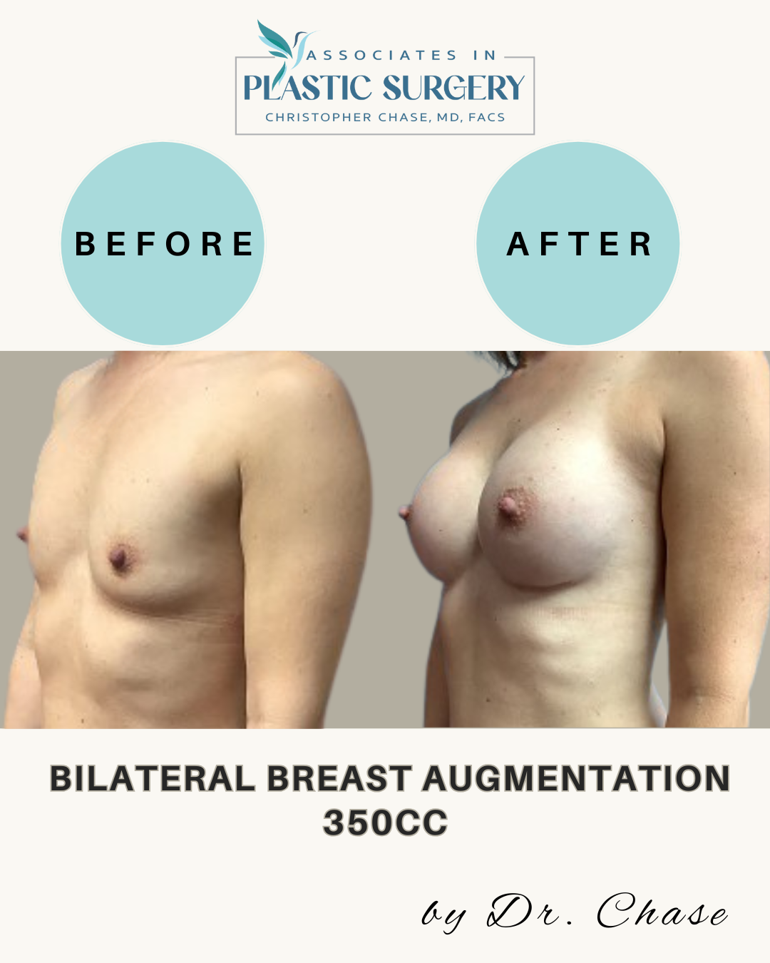 Breast augmentation comparison: before/after breasts. Light blue circles label the images. 350CC.