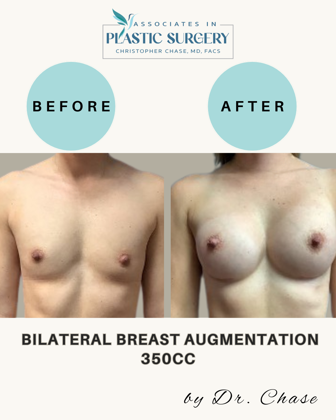 Two images show a chest before and after breast augmentation with text overlay: 